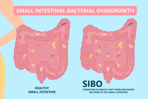 SIBO srovnání normální střeva vs. SIBO